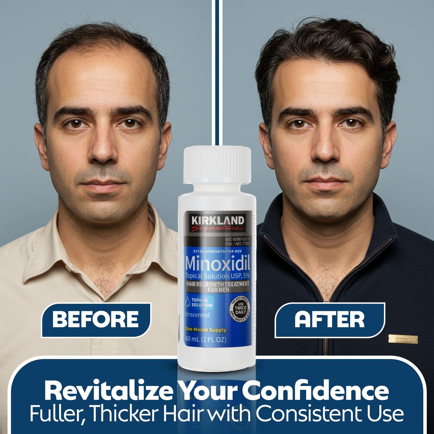 Result within 14 Days:: Imported Minoxidil 5% Extra Strength Hair Regrowth Treatment for Men